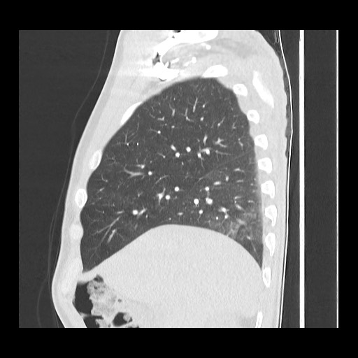 Accessory left horizontal fissure with lingular pneumonia (Radiopaedia 53763-59843 Sagittal lung window 20).jpg