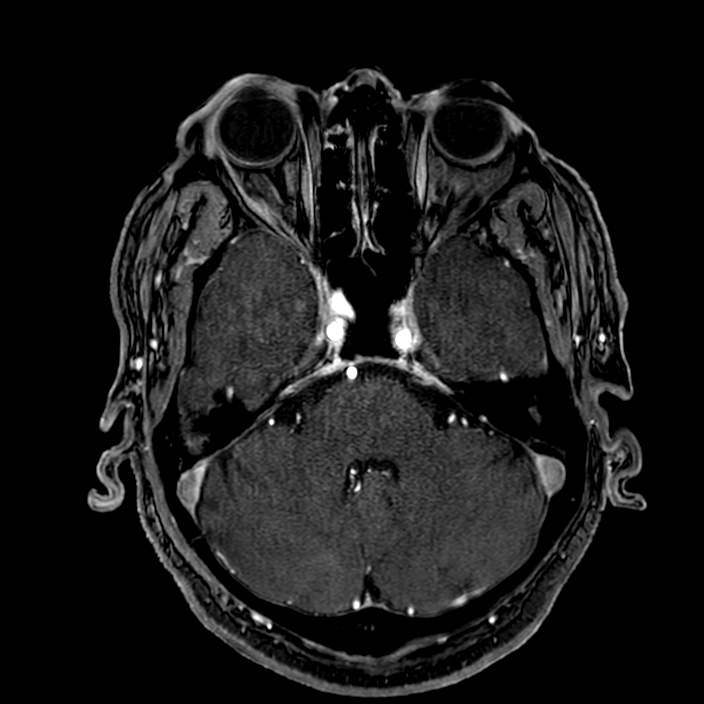 Accessory middle cerebral artery (Radiopaedia 73114-83828 Axial MRA 44).jpg