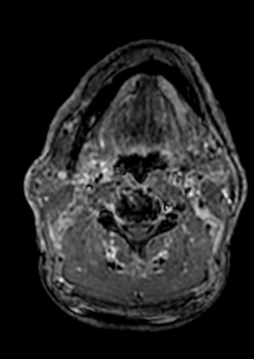 Accessory middle cerebral artery (Radiopaedia 73114-83828 Axial T1 C+ 305).jpg
