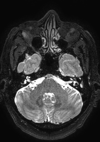 Accessory middle cerebral artery (Radiopaedia 73114-83828 Axial T2 166).jpg