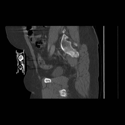 File:Acetabular fracture (Radiopaedia 13193-13212 Sagittal bone window 34).jpg