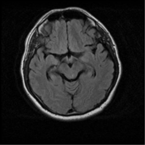 File:Acoustic schwannoma (Radiopaedia 33045-34060 Axial FLAIR 9).png