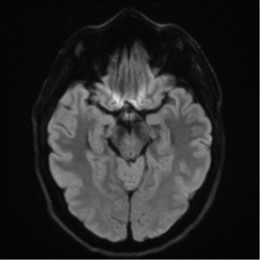 Acoustic schwannoma (Radiopaedia 50846-56358 Axial DWI 39).png