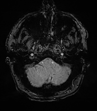 Acoustic schwannoma (Radiopaedia 50846-56358 Axial SWI 12).png