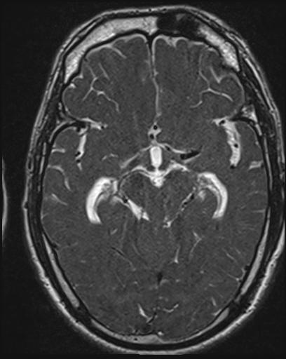 File:Acoustic schwannoma - probable (Radiopaedia 20386-20292 Axial T1 63).jpg