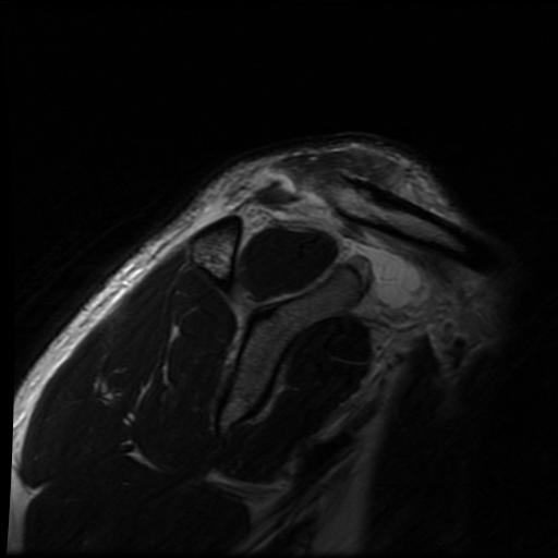 File:Acromioclavicular joint dislocation (Radiopaedia 14218-14076 Sagittal T2 12).jpg