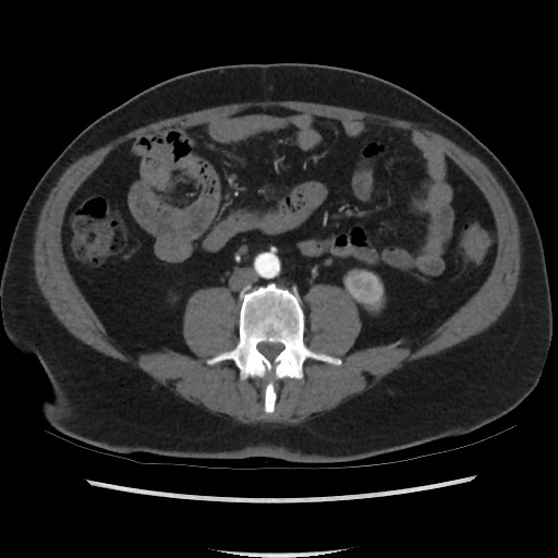 Active colonic bleed on CT (Radiopaedia 49765-55025 Axial C+ arterial phase 46).jpg