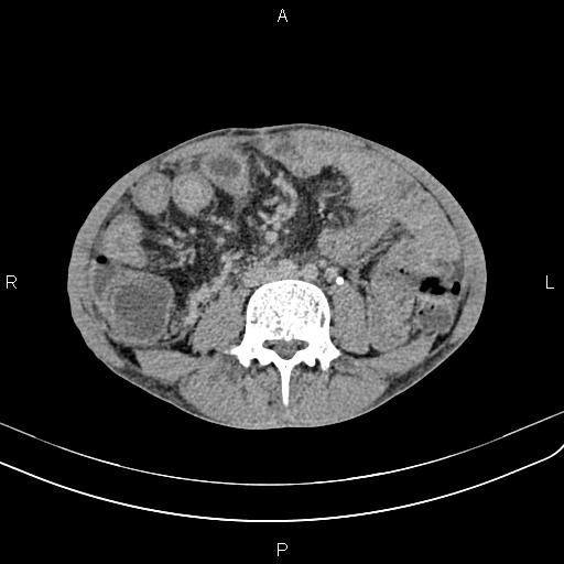 Active crohn disease (Radiopaedia 87133-103397 Axial C+ delayed 35).jpg