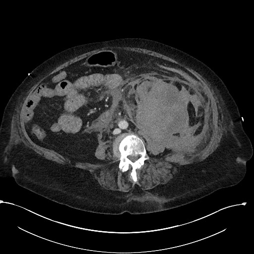 File:Active renal extravasation with large subcapsular and retroperitoneal hemorrhage (Radiopaedia 60975-68796 Axial 229).jpg
