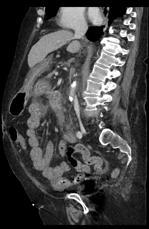 Active renal extravasation with large subcapsular and retroperitoneal hemorrhage (Radiopaedia 60975-68796 Sagittal C+ portal venous phase 128).jpg