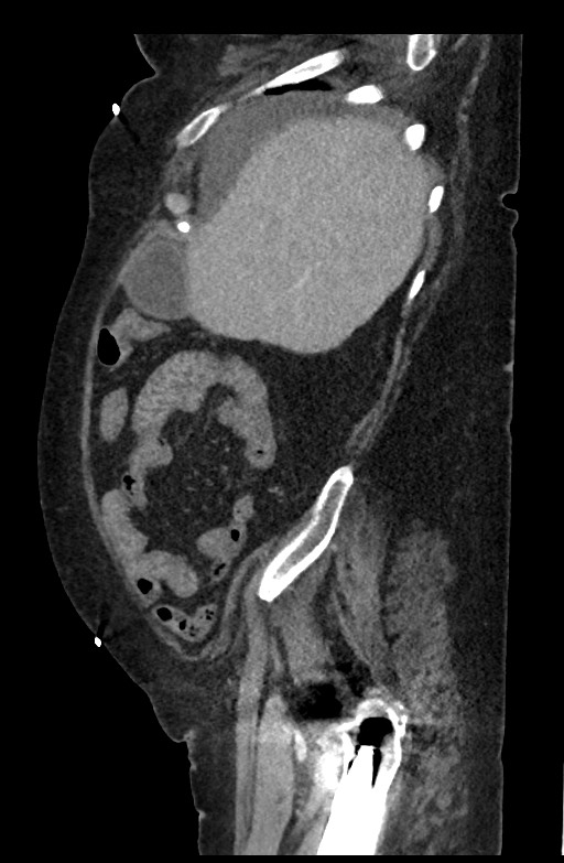 Active renal extravasation with large subcapsular and retroperitoneal hemorrhage (Radiopaedia 60975-68796 Sagittal C+ portal venous phase 175).jpg