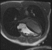 File:Active right ventricular cardiac sarcoidosis (Radiopaedia 55596-62100 Axial Dynamic perfusion scan MOCO 53).jpg