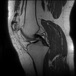 File:Acute-on-chronic transient lateral patellar dislocation with trochlear dysplasia (Radiopaedia 84099-99349 Sagittal PD 74).jpg