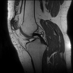 Acute-on-chronic transient lateral patellar dislocation with trochlear dysplasia (Radiopaedia 84099-99349 Sagittal PD 76).jpg