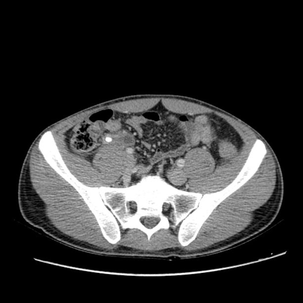 Acute appendicitis (Radiopaedia 27049-27227 Axial C+ portal venous phase 55).jpg