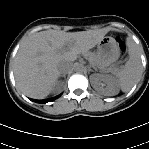 Acute appendicitis (Radiopaedia 30261-30888 Axial non-contrast 8).jpg