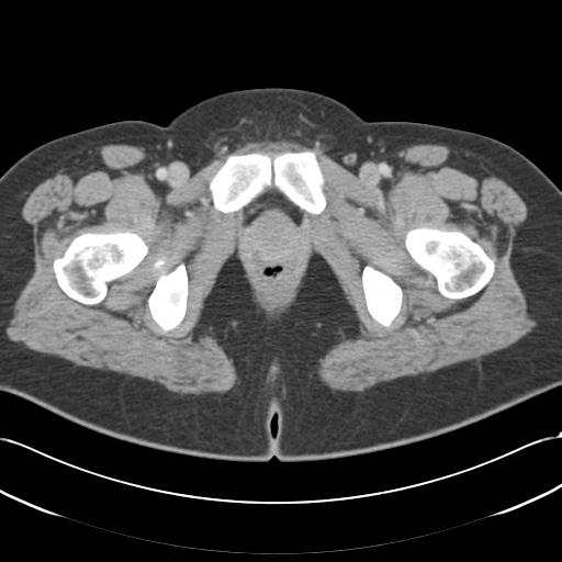 Acute appendicitis (Radiopaedia 30297-30934 Axial C+ portal venous phase 83).jpg