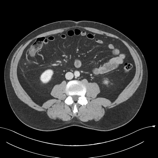 Acute appendicitis (Radiopaedia 36611-38177 Axial C+ portal venous phase 52).png