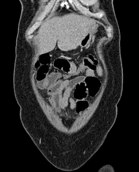 File:Acute appendicitis (Radiopaedia 48792-53822 Coronal C+ portal venous phase 50).jpg