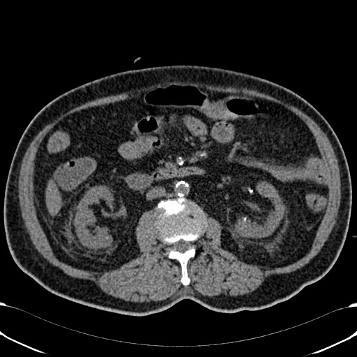 Acute appendicitis (Radiopaedia 58627-65818 Axial non-contrast 41).jpg