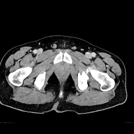 File:Acute appendicitis (Radiopaedia 77016-88960 Axial C+ portal venous phase 146).jpg