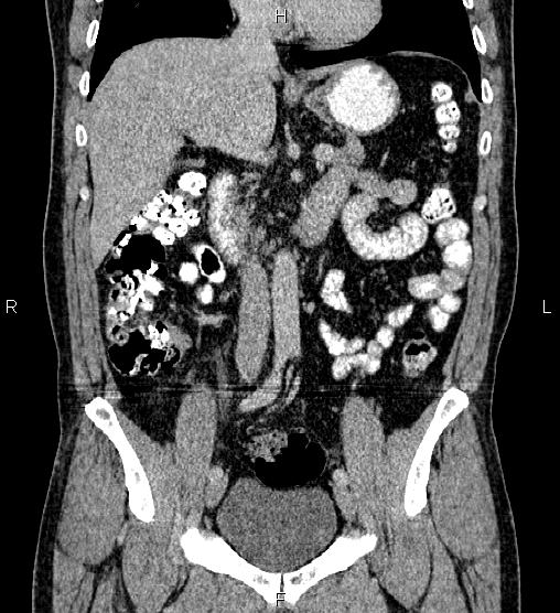 Acute appendicitis (Radiopaedia 84780-100240 Coronal C+ portal venous phase 37).jpg