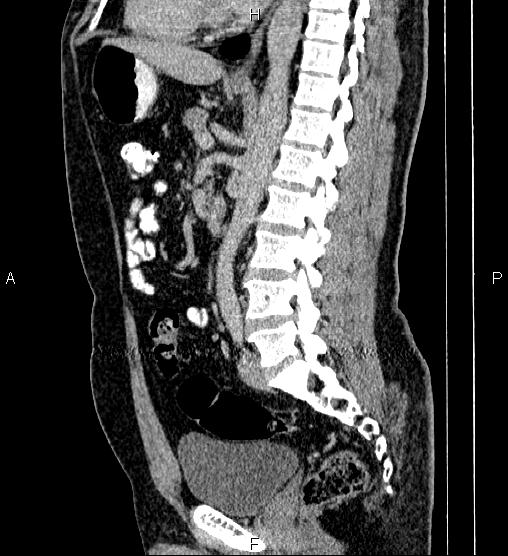 Acute appendicitis (Radiopaedia 84780-100240 Sagittal C+ portal venous phase 57).jpg