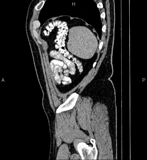 File:Acute appendicitis (Radiopaedia 84780-100240 Sagittal C+ portal venous phase 96).jpg