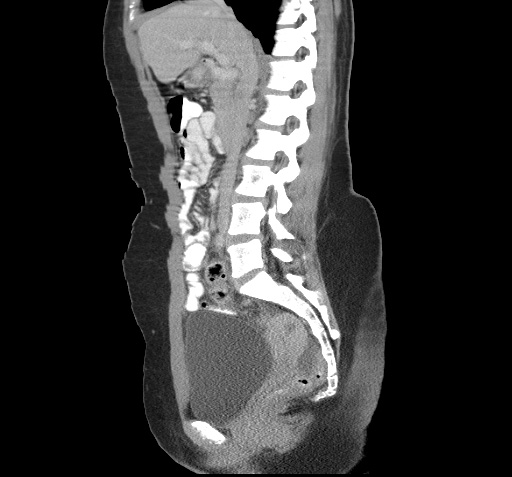 File:Acute appendicitis (Radiopaedia 9417-10099 Sagittal C+ portal venous phase 2).jpg