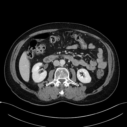 Acute appendicitis - large appendicoliths (Radiopaedia 61805-69820 Axial C+ portal venous phase 58).jpg