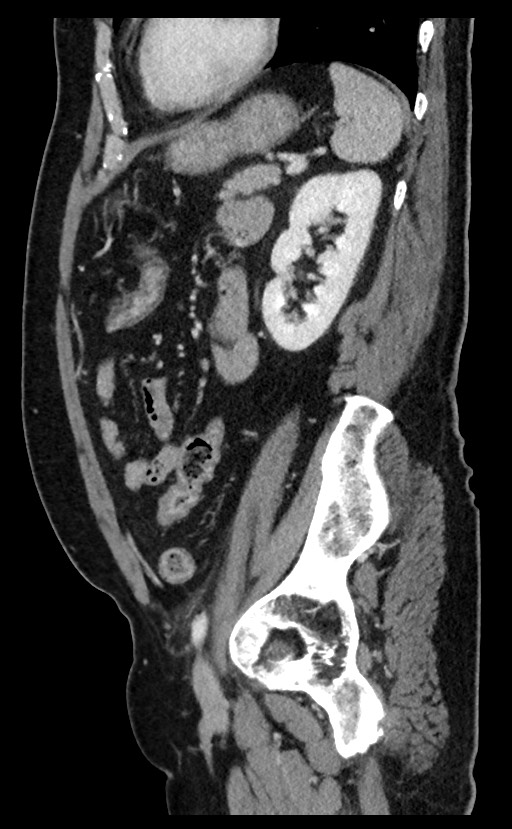 Acute appendicitis - large appendicoliths (Radiopaedia 61805-69820 Sagittal C+ portal venous phase 35).jpg