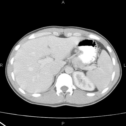 File:Acute appendicitis with CT arrowhead sign (Radiopaedia 21474-21411 Axial C+ portal venous phase 8).jpg
