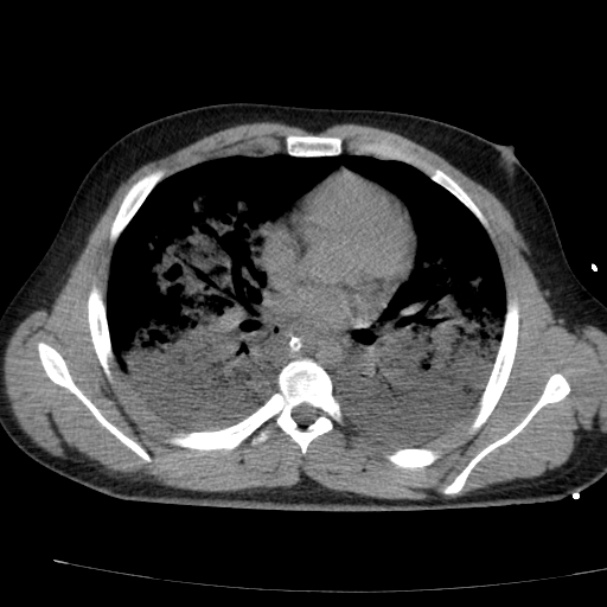 Acute aspiration pneumonitis (Radiopaedia 33605-34703 Axial non-contrast 48).jpg