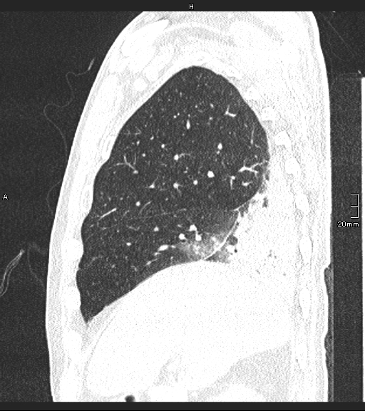 Acute aspiration pneumonitis (Radiopaedia 55642-62166 Sagittal lung window 116).jpg