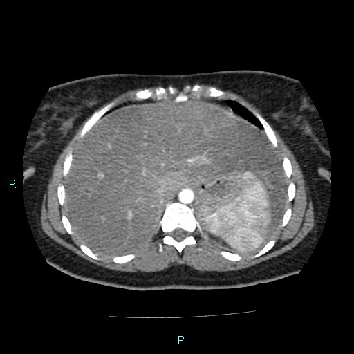File:Acute bilateral pyelonephritis (Radiopaedia 37146-38881 Axial C+ arterial phase 22).jpg