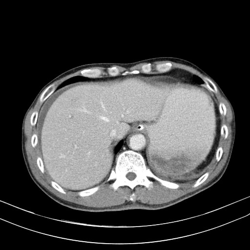 Acute bowel ischemia (Radiopaedia 87695-104114 Axial C+ portal venous phase 16).jpg