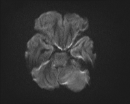 File:Acute cerebellar ataxia (Radiopaedia 61487-69446 Axial DWI 5).jpg