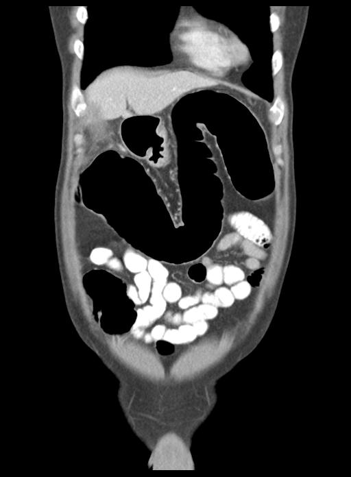 Acute cholecystitis (Radiopaedia 29814-30327 Coronal C+ portal venous phase 13).jpg