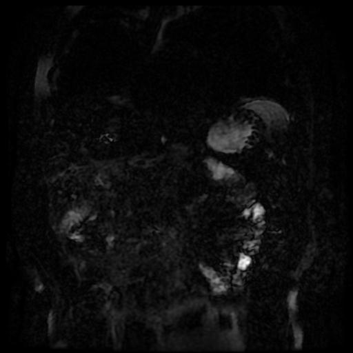 Acute cholecystitis and biliary hamartomas (Radiopaedia 86231-102240 E 133).jpg