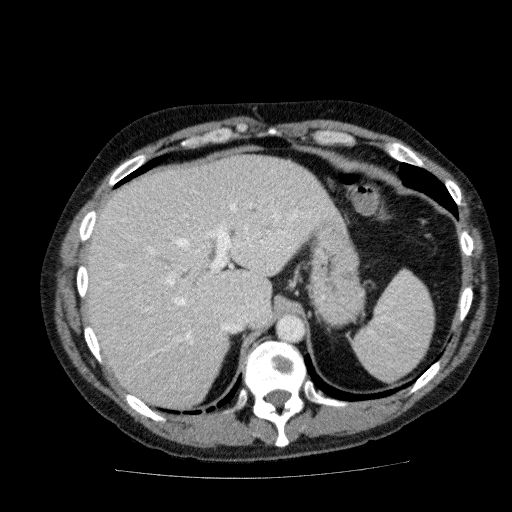 File:Acute cholecystitis and incidental left sided IVC (Radiopaedia 49352-54459 Axial C+ portal venous phase 38).jpg