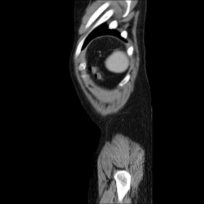 Acute cholecystitis and incidental left sided IVC (Radiopaedia 49352-54459 Sagittal C+ portal venous phase 11).jpg