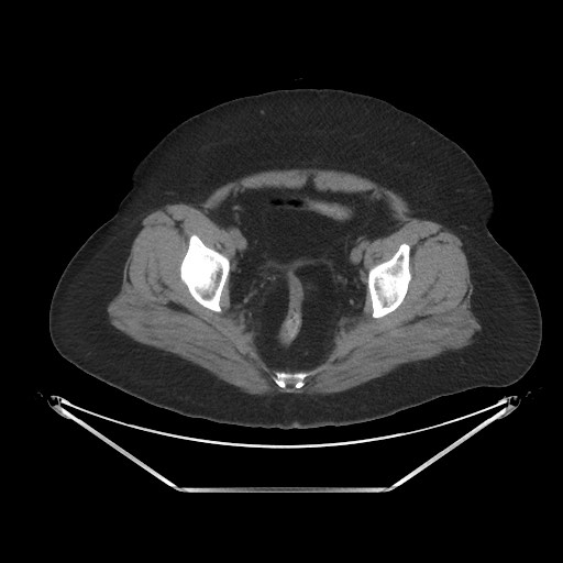 File:Acute cholecystitis with tensile fundus sign (Radiopaedia 71394-81723 Axial non-contrast 104).jpg
