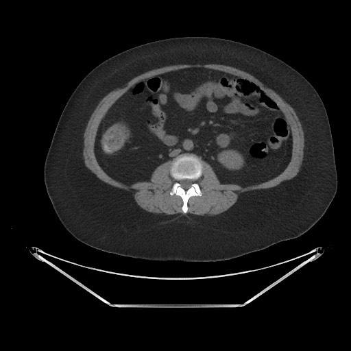 File:Acute cholecystitis with tensile fundus sign (Radiopaedia 71394-81723 Axial non-contrast 48).jpg