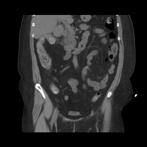 Acute cholecystitis with tensile fundus sign (Radiopaedia 71394-81723 Coronal non-contrast 61).jpg