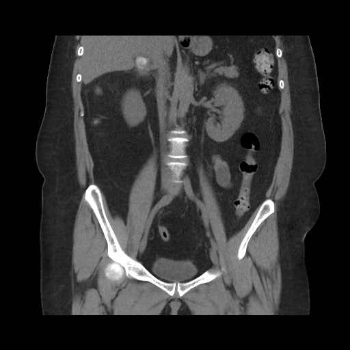 Acute cholecystitis with tensile fundus sign (Radiopaedia 71394-81723 Coronal non-contrast 70).jpg