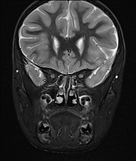 File:Acute disseminating encephalomyelitis with bilateral optic neuritis (Radiopaedia 79676-92886 Coronal STIR 11).jpg
