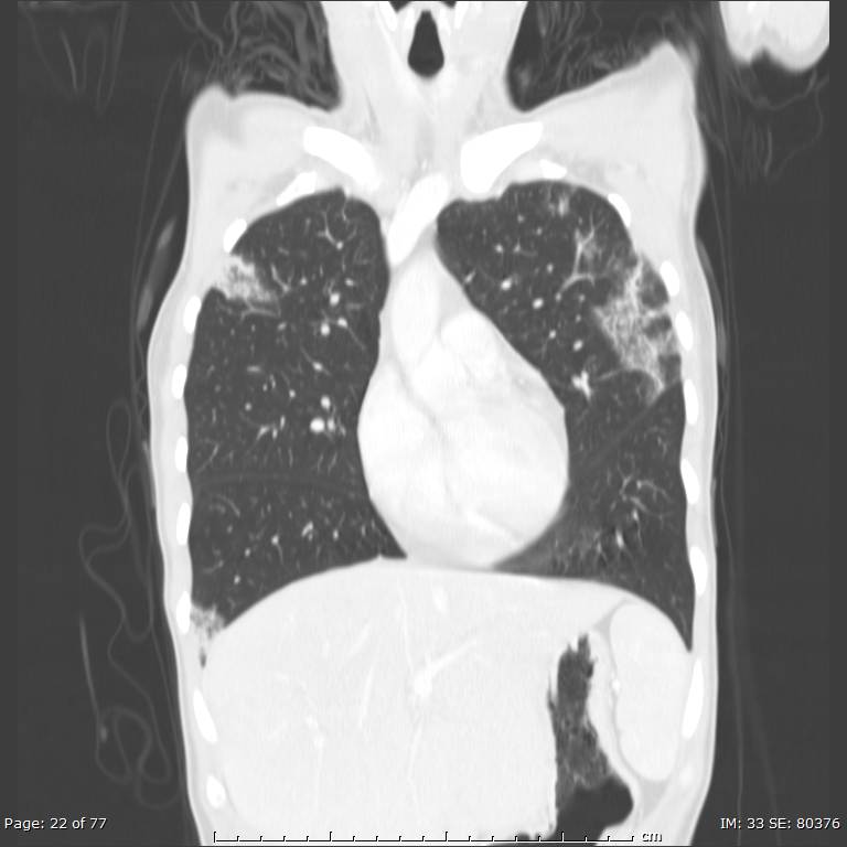 Acute eosinophilic pneumonia (Radiopaedia 48211-53073 Coronal lung window 14).jpg