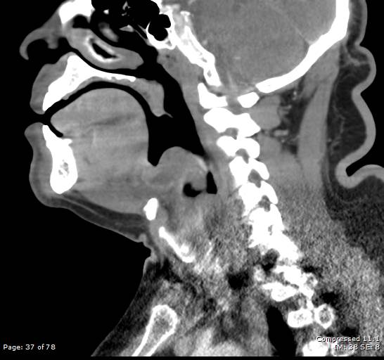 Acute epiglottitis (Radiopaedia 54375-60590 Sagittal C+ arterial phase 37).jpg