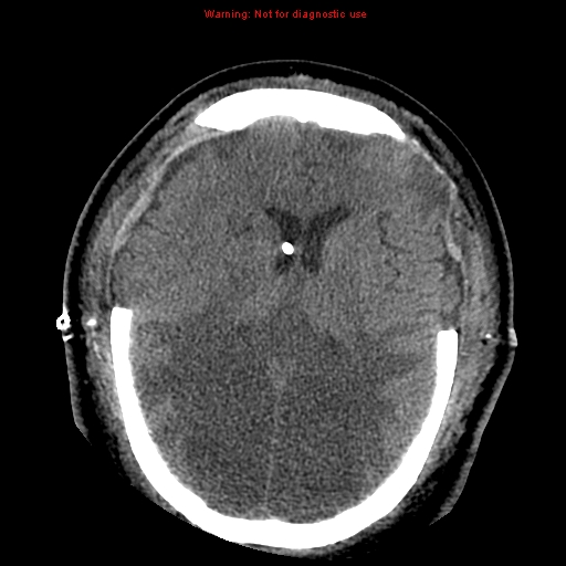 Acute hemorrhagic leukoencephalitis (Radiopaedia 14076-43697 Axial non-contrast 29).jpg