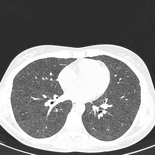 File:Acute hypersensitivity pneumonitis (Radiopaedia 85293-100870 Axial lung window 70).jpg